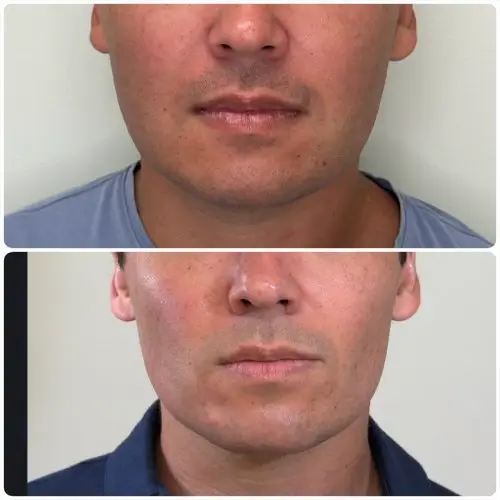 Buccal Fat Removal, front view, patient in his 30s, lower face sculpting, case 1