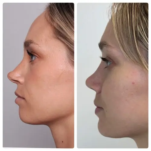 Rhinoplasty, left profile, patient in her 20s, tip deprojection and function, 6 months post-op, case 9