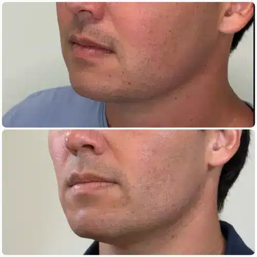 Buccal Fat Removal, left oblique, patient in his 30s, lower face sculpting, case 1