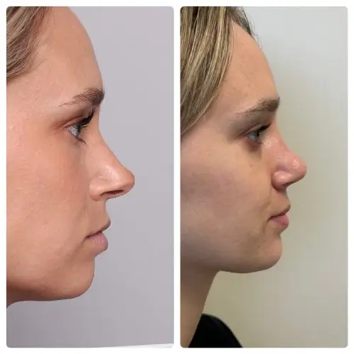 Rhinoplasty, right profile, patient in her 20s, tip deprojection and function, 6 months post-op, case 9