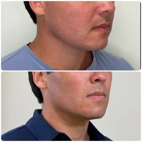 Buccal Fat Removal, right oblique, patient in his 30s, lower face sculpting, case 1