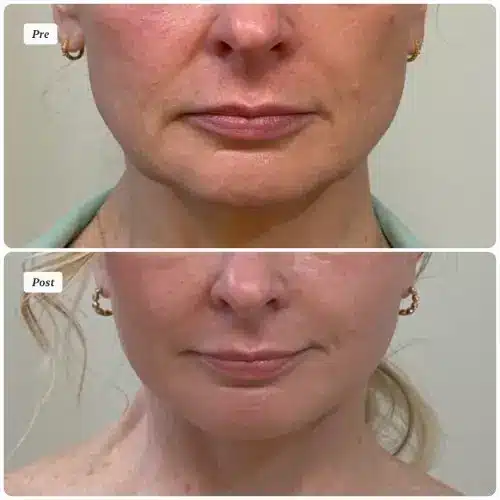 Deep plane facelift and neck lift, front view, patient in her 50s, jowling and perioral concerns, 3 months post-op, case 3