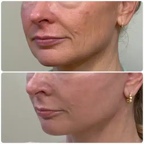 Deep plane facelift and neck lift, left oblique, patient in her 50s, jowling and perioral concerns, 3 months post-op, case 3