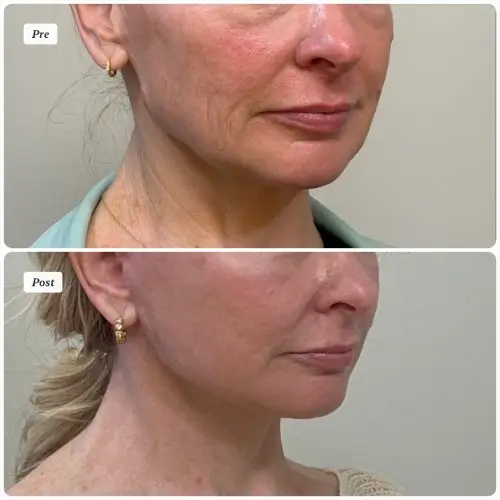 Deep plane facelift and neck lift, right oblique, patient in her 50s, jowling and perioral concerns, 3 months post-op, case 3