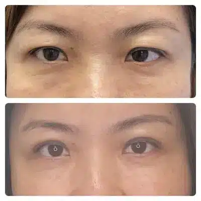 Asian blepharoplasty double eyelid surgery, front view, patient in her 40s, case 4