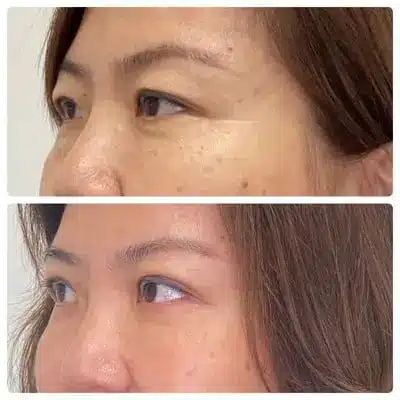 Asian blepharoplasty double eyelid surgery, left oblique, patient in her 40s, case 4