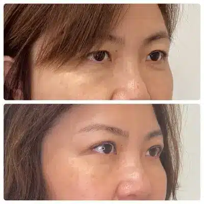 Asian blepharoplasty double eyelid surgery, right oblique, patient in her 40s, case 4
