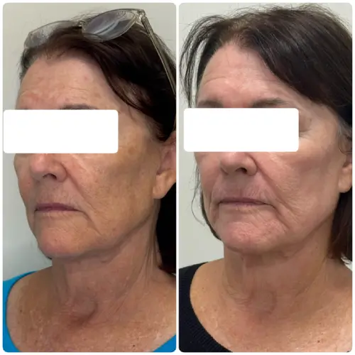 Sun damage and age spot treatment, right oblique, patient in her 60s, case 10