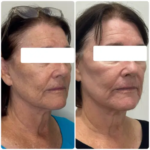 Sun damage and age spot treatment, left oblique, patient in her 60s, case 10