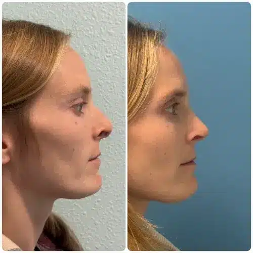 Rhinoplasty, right profile, patient in her 30s, alar retraction and deviated septum correction, 6 months post-op, case 1