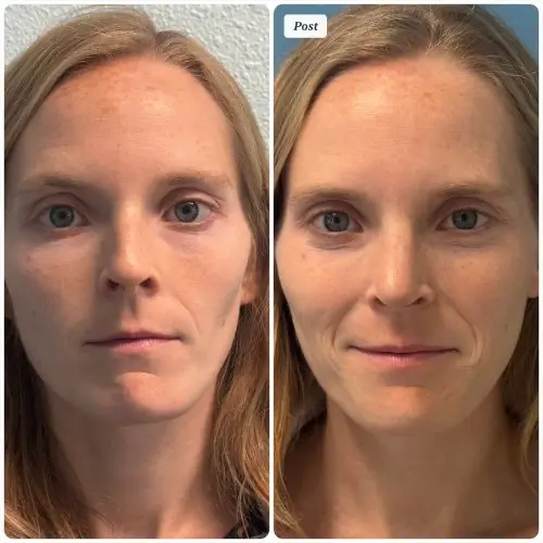 Rhinoplasty, front view, patient in her 30s, alar retraction and deviated septum correction, 6 months post-op, case 1