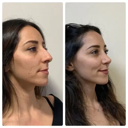 Rhinoplasty, front view, patient in her 30s, nose reduction, profile and tip, 6 months post-op, case 14