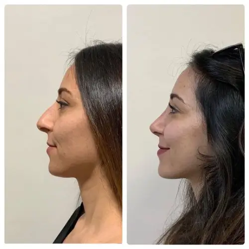 Rhinoplasty, left profile, patient in her 30s, nose reduction, profile and tip, 6 months post-op, case 14