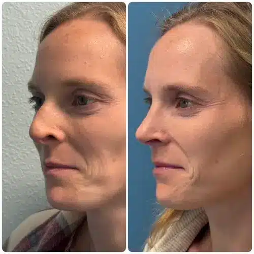 Rhinoplasty, left oblique, patient in her 30s, alar retraction and deviated septum correction, 6 months post-op, case 1