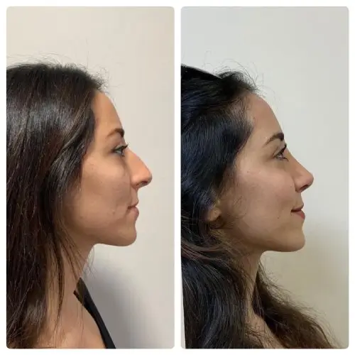 Rhinoplasty, right profile, patient in her 30s, nose reduction, profile and tip, 6 months post-op, case 14