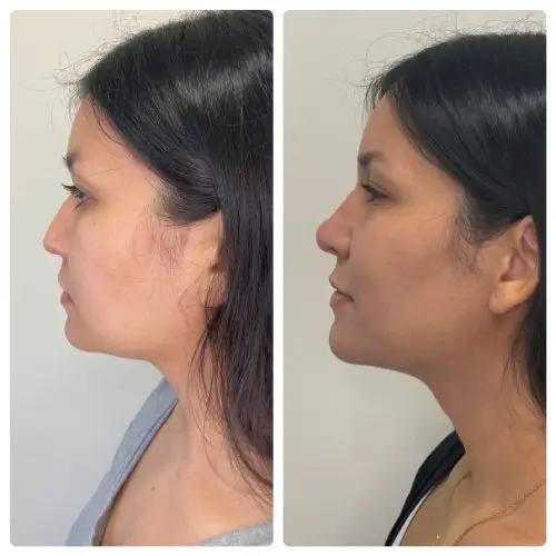 Rhinoplasty, left profile, 1 year post-op, case 15