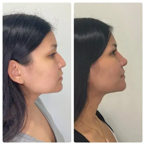 Rhinoplasty, right profile, 1 year post-op, case 15