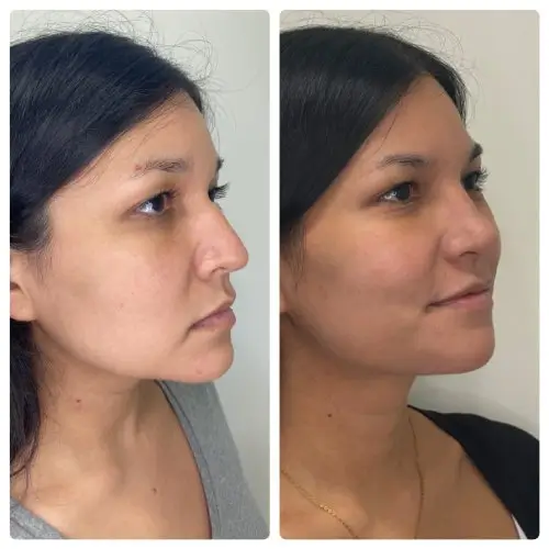 Rhinoplasty, right oblique, 1 year post-op, case 15
