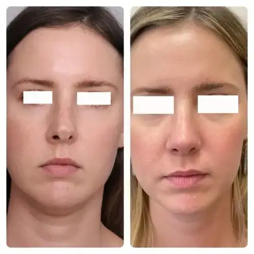 Rhinoplasty, front view, patient in her 30s, tip and profile refinement, 1 year post-op, case 5