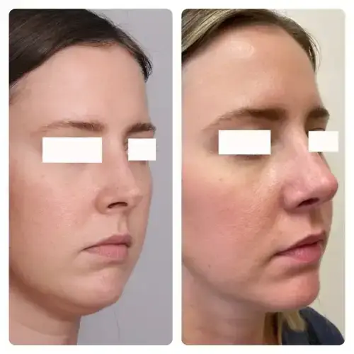 Rhinoplasty, right oblique, patient in her 30s, tip and profile refinement, 1 year post-op, case 5