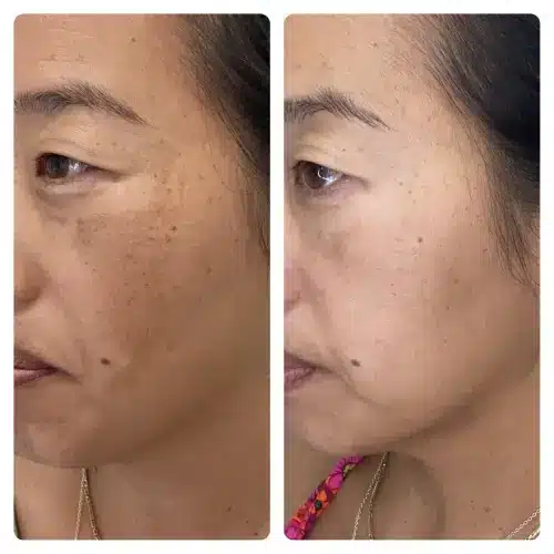 Melasma treatment, left oblique, pigmentation protocol with medical-grade skincare and in-office treatment, case 2