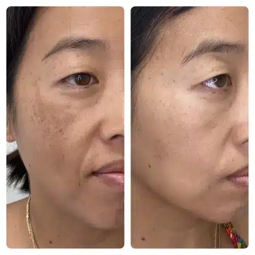 Melasma treatment, right oblique, pigmentation protocol with medical-grade skincare and in-office treatment, case 2