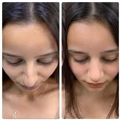 Rhinoplasty, right profile, patient in her 20s, crooked nose and deviated septum correction, 1 year post-op, case 13