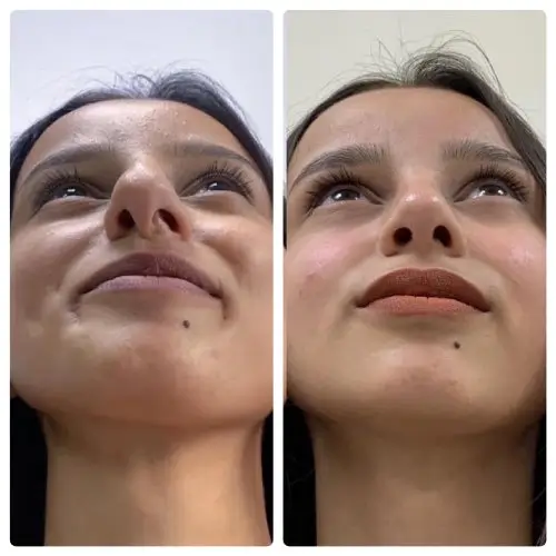 Rhinoplasty, base view, patient in her 20s, crooked nose and deviated septum correction, 1 year post-op, case 13