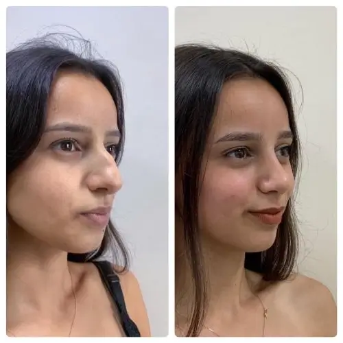 Rhinoplasty, right oblique, patient in her 20s, crooked nose and deviated septum correction, 1 year post-op, case 13