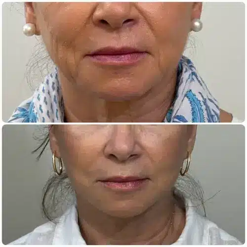 Facelift and neck lift, front view, patient in her late 50s, improved jowls and jawline, 6 months post-op, case 1