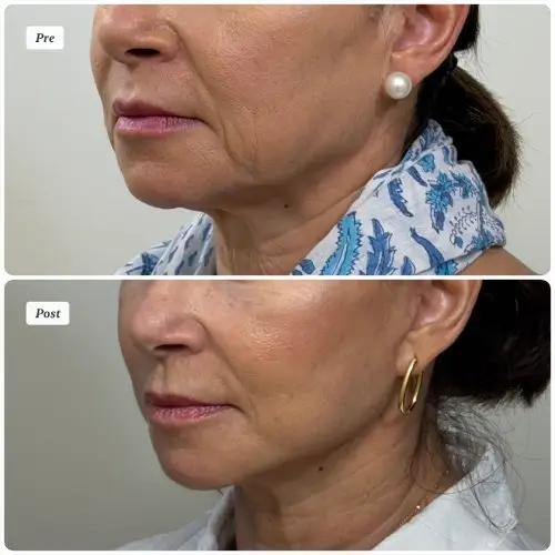 Facelift and neck lift, left oblique, patient in her late 50s, improved jowls and jawline, 6 months post-op, case 1