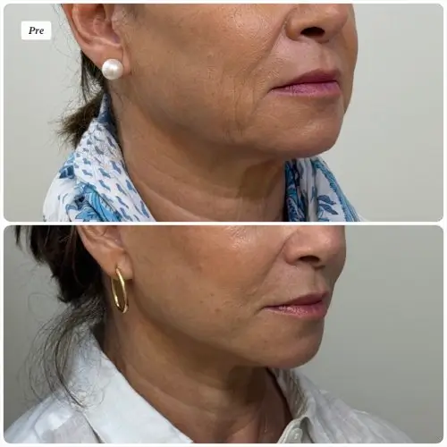 Facelift and neck lift, right oblique, patient in her late 50s, improved jowls and jawline, 6 months post-op, case 1