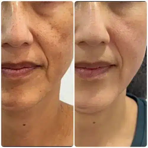 Melasma and hyperpigmentation treatment, front view, patient in her 40s, medical-grade skin protocol with laser and chemical peel, 6 months follow-up, case 1
