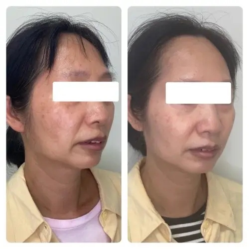 Melasma and hyperpigmentation treatment, right oblique, patient in her 40s, medical-grade skin protocol with laser and chemical peel, 6 months follow-up, case 1