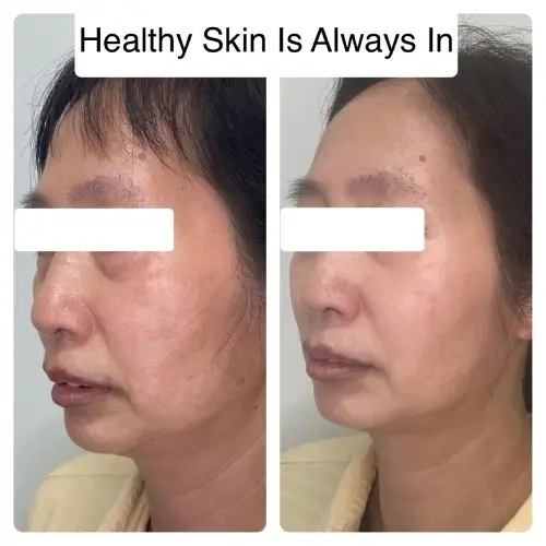 Melasma and hyperpigmentation treatment, left oblique, patient in her 40s, medical-grade skin protocol with laser and chemical peel, 6 months follow-up, case 1