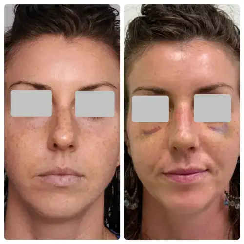 Rhinoplasty, front view, patient in her 30s, early post-op with swelling, case 6