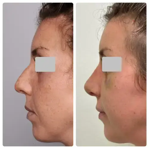 Rhinoplasty, left profile, patient in her 30s, early post-op with swelling, case 6