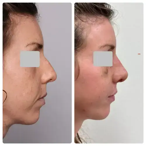 Rhinoplasty, right profile, patient in her 30s, early post-op with swelling, case 6