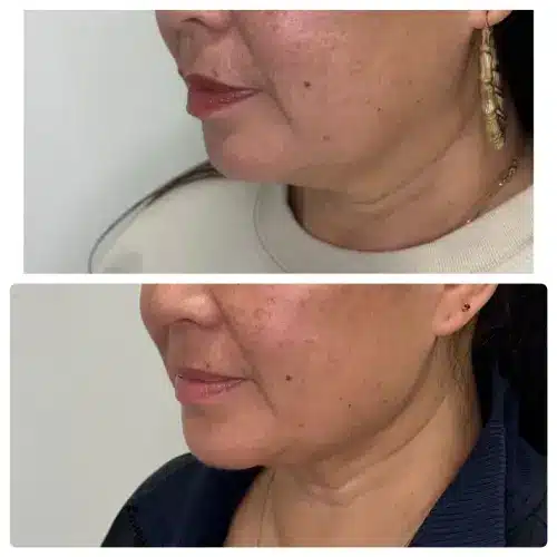 FaceTite radiofrequency facial contouring, profile view, result 2