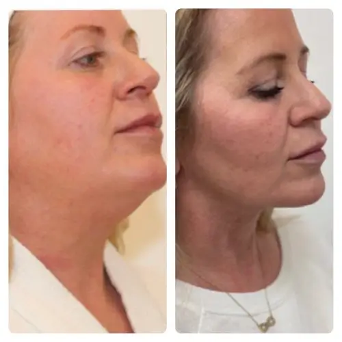 FaceTite radiofrequency facial contouring, profile view, result 3