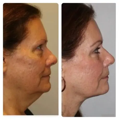 FaceTite radiofrequency facial contouring, profile view, result 1