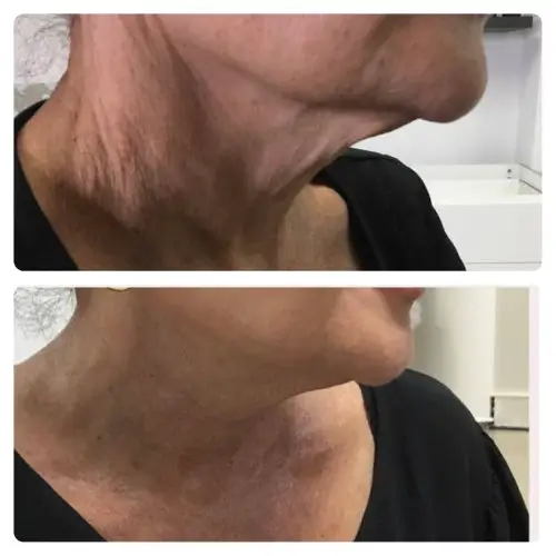 FaceTite radiofrequency facial contouring, profile view, result 6