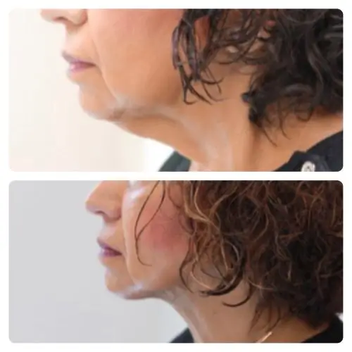 FaceTite radiofrequency facial contouring, profile view, result 5