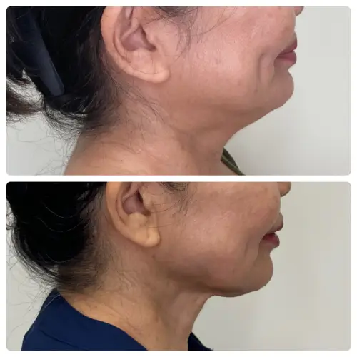 FaceTite radiofrequency facial contouring, profile view, result 4