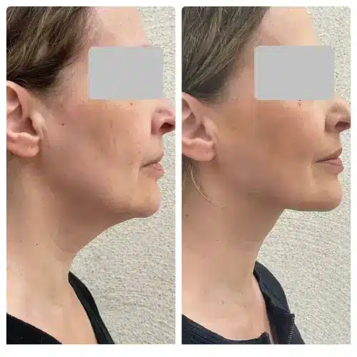 FaceTite radiofrequency facial contouring, profile view, result 7