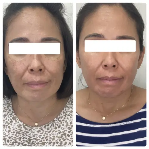 Melasma treatment, front view, patient in her 40s, RF microneedling, laser and chemical peels with at-home care, case 7