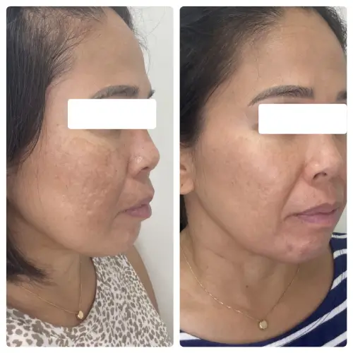 Melasma treatment, right oblique, patient in her 40s, RF microneedling, laser and chemical peels with at-home care, case 7
