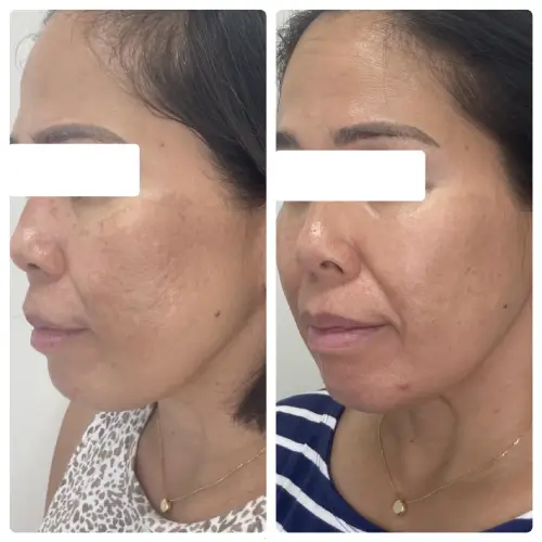 Melasma treatment, left oblique, patient in her 40s, RF microneedling, laser and chemical peels with at-home care, case 7