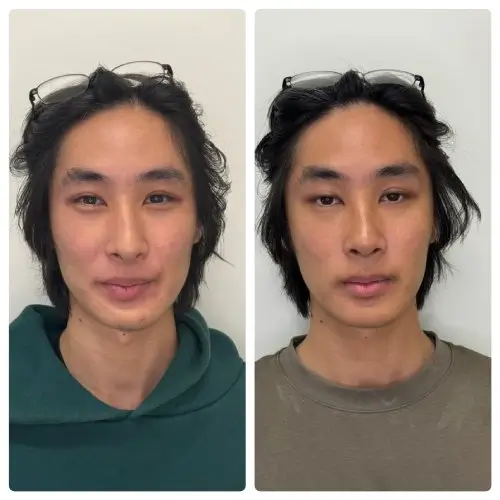 Rhinoplasty, front view, 3 months post-op, case 16