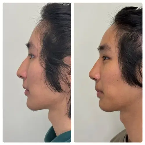 Rhinoplasty, left profile, 3 months post-op, case 16